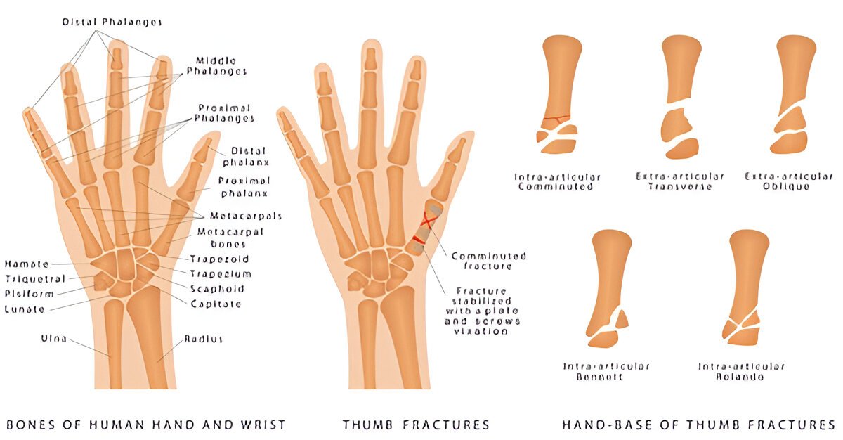 Thumb Fracture